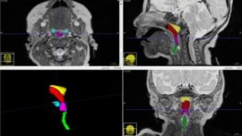 Los prematuros tienen más estrechas las vías respiratorias superiores